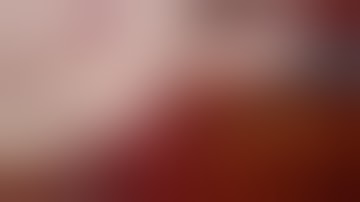 TEP Laparoscopic Inguinal Hernia Repair Using Lap Progrip Self-Fixating Mesh