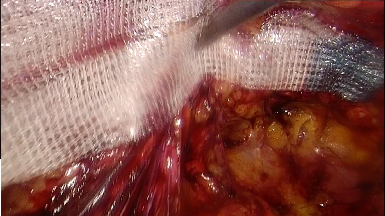 TEP Laparoscopic Inguinal Hernia Repair Using Lap Progrip Self-Fixating Mesh