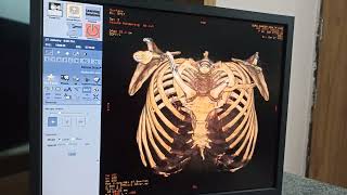 CT 3D Chest #ct #ctscan #thirasiccavity screenshot 4