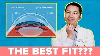 A MUST WATCH: How to Get the Best Scleral Lens Fit!!!!!