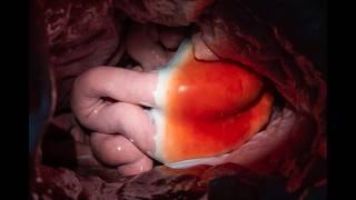 3 Foods Extreme Bloating The Hidden Gut Destroyer Stomach Secrets