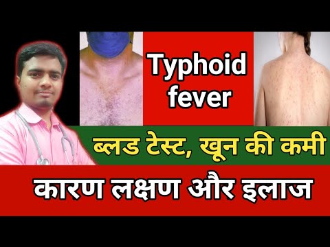 Typhoid Fever. टाइफाइड बुखार के कारण लक्षण और इलाज. Typhoid Fever,Test, Causes, Symptoms. Treatment