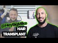 Hair transplant story of famous youtuber mike majlak  heybigmike   smile hair clinic