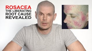 Rosacea, the liberating root cause revealed.