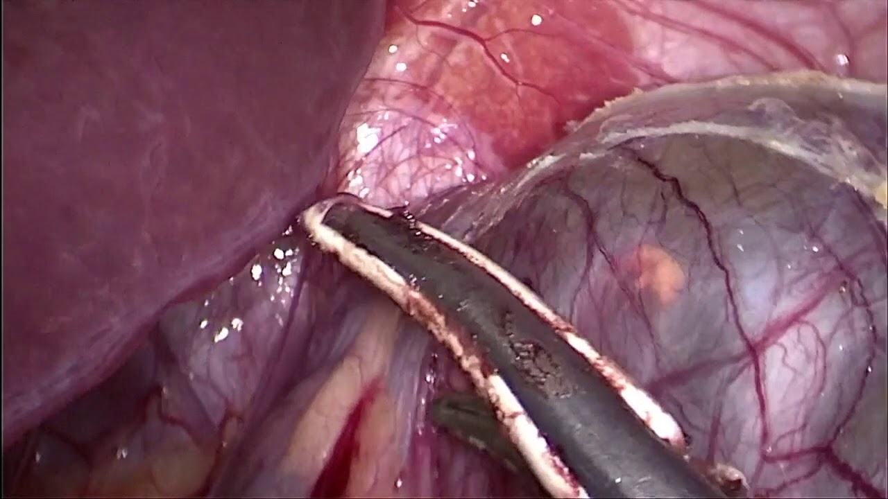 camera iphone 8 plus apk LIVE LAPAROSCOPIC LEFT ADRENALECTOMY - DR.MUAYAD ABASS FADHEL