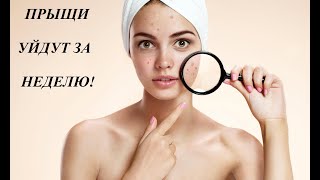 Прыщи пройдут за неделю!8 способов избавиться от акне. Узнай причины их появления и методы лечения!