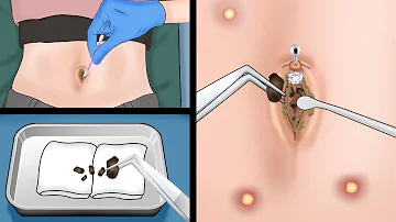 Is Your Belly Button Clean? ASMR Remove Navel Stone Animation | WOW Brain Animation