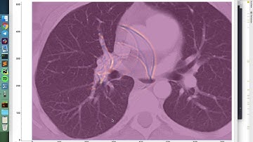 Sound Propagation in Lungs (acoustic FDTD simulation)