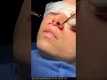 The Subnasal lip lift, Bullhorn lip lift, Upper lip lift by Dr. Anurag Agarwal