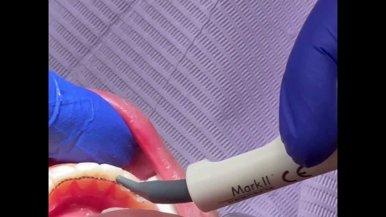 Bonded “Permanent” lingual retainer technique YouTube