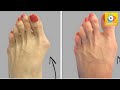 Voici comment se dbarrasser des oignons de pieds naturellement   random888