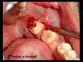 Surgical Extraction of Impacted Mandibular Left 3rd Molar