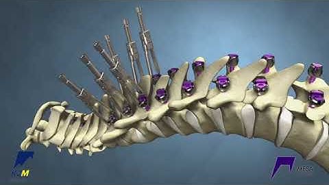 Stryker (K2M): MESA Rail Deformity Spinal System
