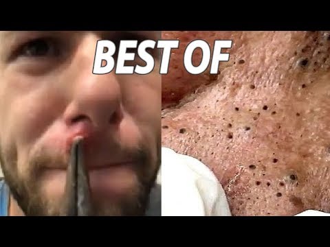 Blackheads Under the Microscope!  Pimple Pops & Cystic Acne Removal