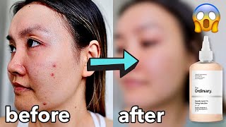I Tried The Ordinary Glycolic Acid Toner Every Day For A Week & This Happened