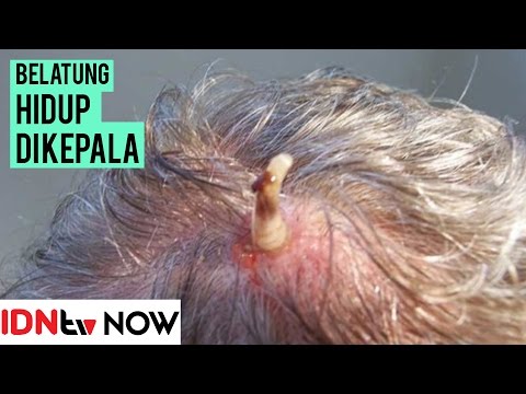 Ngeri Banget! Seekor Belatung Hidup di Dalam Kulit Kepala Pria Ini | IDNtv NOW