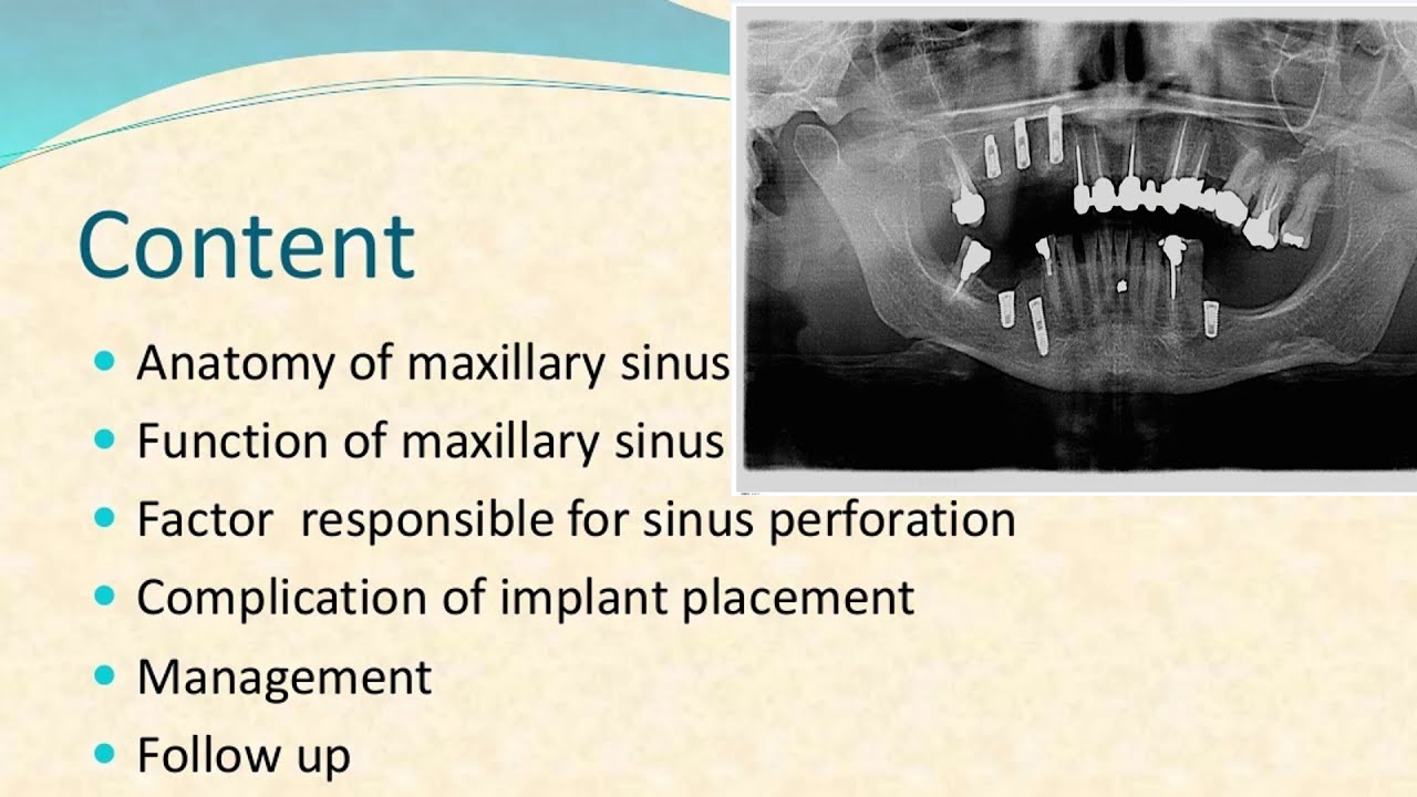 dental implant displacement into maxillary sinus YouTube