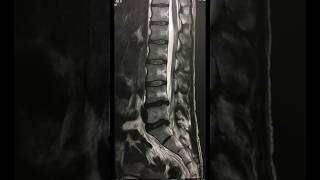 Lumbar disc bulges L4 L5, L5 S1 disc bulges #sciatica #backpain #sciaticapainrelief #fitfam #gym