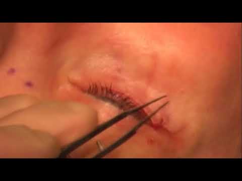 Video: Øjenlåge Blepharoplasty: Fordele Og Ulemper