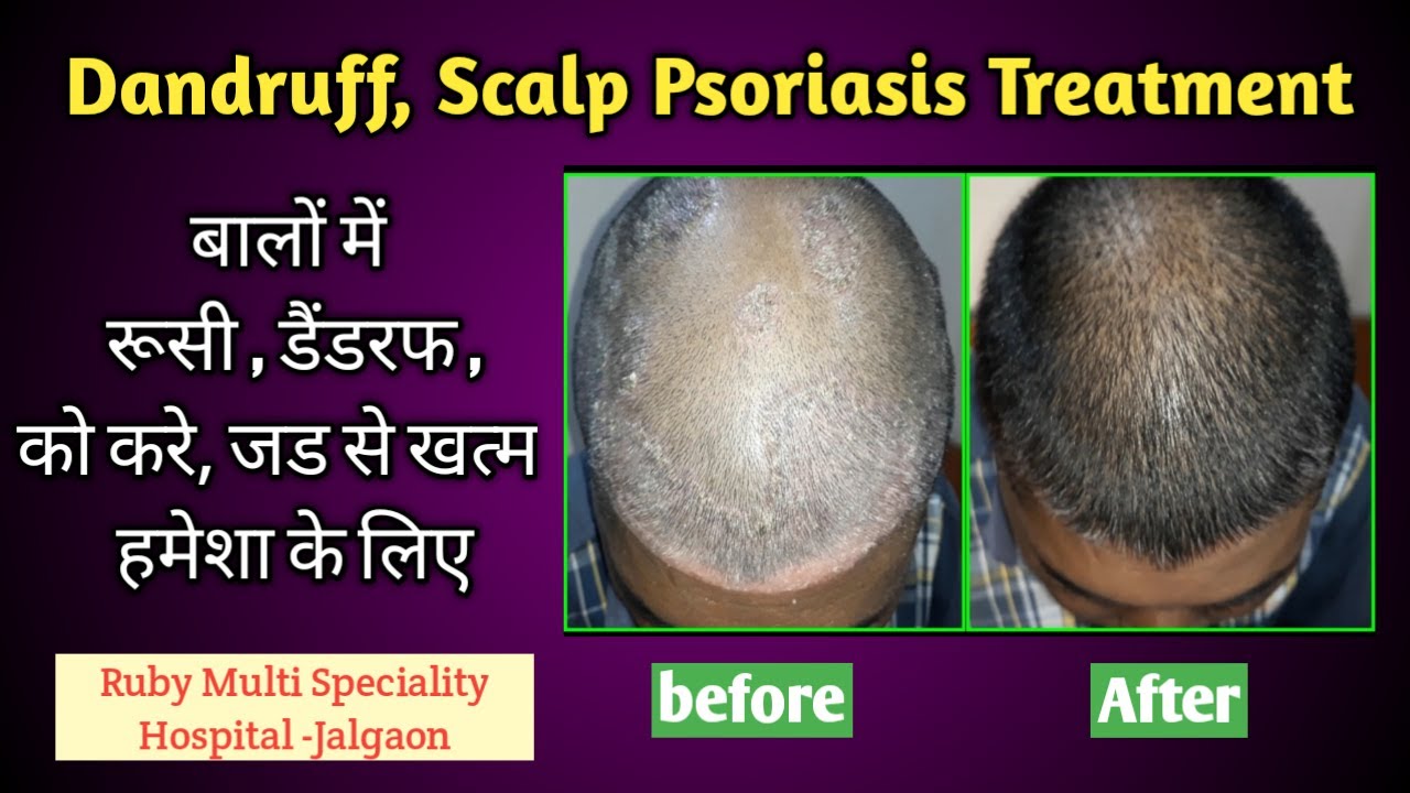 Dandruff & Scalp Psoriasis Treatment YouTube