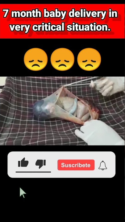 7 month baby delivery. #shorts #shortvideo #trending #trendingshorts #medical #doctor.