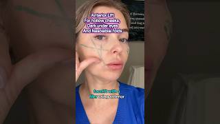 Anterior Cheek Filler for Lift with Cannula