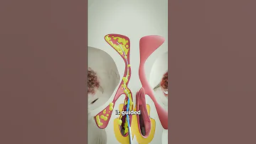 Balloon Sinuplasty 🤔(explained)