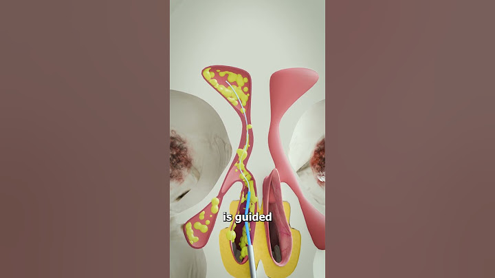 Balloon Sinuplasty 🤔(explained)