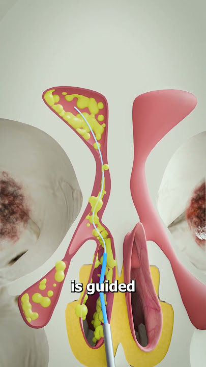 Balloon Sinuplasty 🤔(explained)