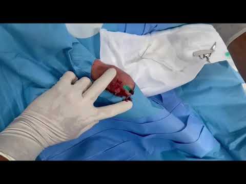 Стентирование коронарных артерий. ДРОН метод