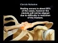 Malunion of the clavicle  everything you need to know  dr nabil ebraheim