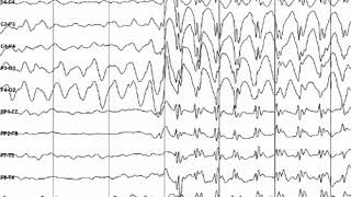 Epilepsy | Wikipedia audio article