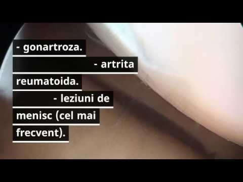 Video: Chistul Genunchiului - Chistul Brutarului (brutarului), Tratament și Intervenție Chirurgicală