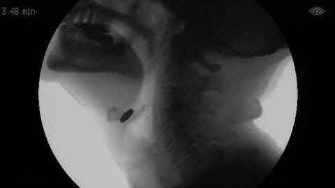 Barium pill stuck in throat (valleculae) & then food tube (esophagus)