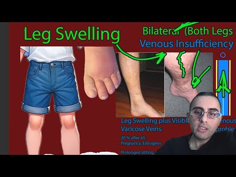 ფეხების შეშუპების მიზეზები.  ერთ ფეხის შეშუპება vs ორივე ფეხის შეშუპება