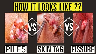 PILES Vs SENTINEL SKIN TAG Vs FISSURE - HOW IT LOOKS ???