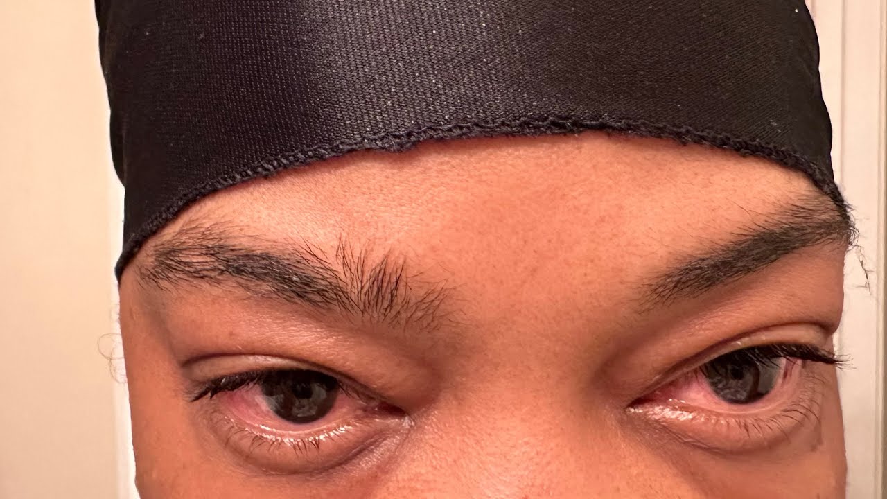 Vogt–Koyanagi–Harada (VKH) Finding out what is wrong with me Part 1 