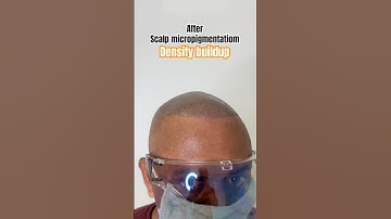 Density buildup in hair transplant failure with scalp micropigmentation #scalpmicropigmentation #smp