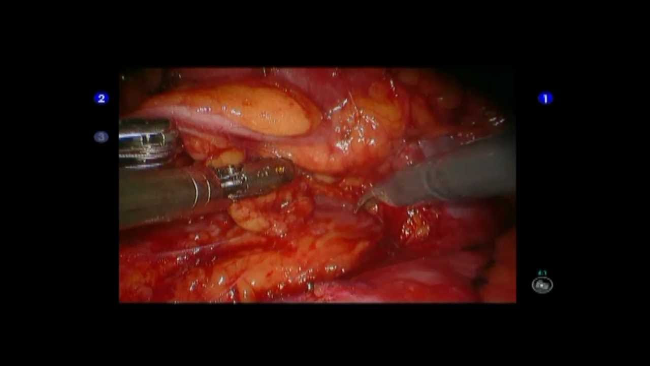 Kidney Cancer Surgical Technique: Early Unclamping Robotic Partial Nephrectomy