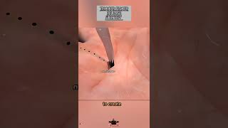 How Trigger Finger Release Surgery Is Done #shorts