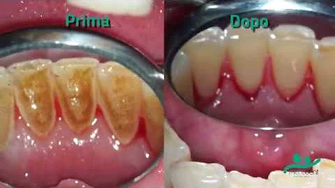 Quanto costa la pulizia dei denti dal dentista?