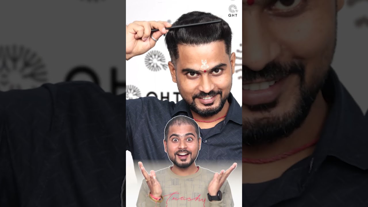 Best Hair Transplant Results Latest Fue Technique Shorts Viral
