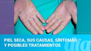 Piel Seca, sus causas, síntomas y posibles tratamientos