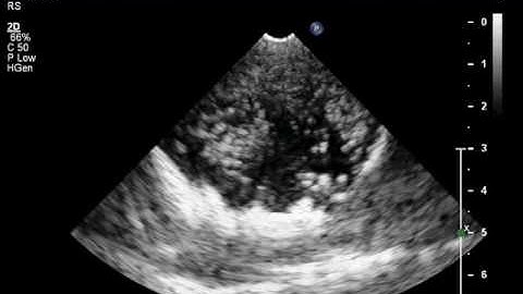 Microbubble Cavitation - High Output Power