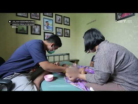 Video: Cara Menyembuhkan Hernia Pada Anak
