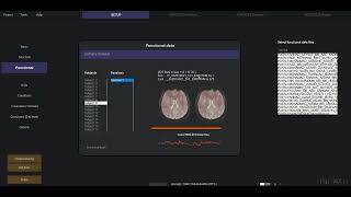1. 0 CONN functional connectivity toolbox Preprocessing