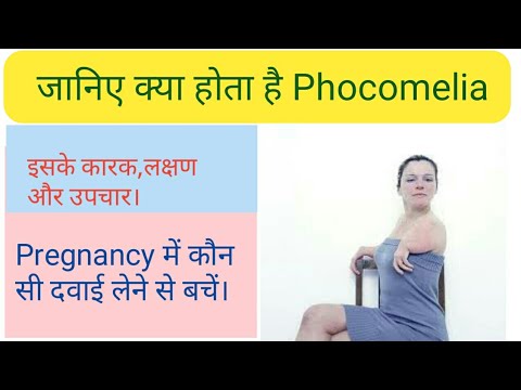 What is Phocomelia, it&rsquo;s cause and treatment.