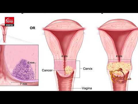 فيديو: 4 طرق للكشف عن سرطان الرحم
