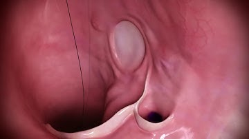 HeartSpan® Steerable Sheath Introducer