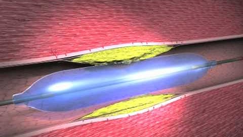 Teaching Science to Juries: Stent Litigation and Restenosis